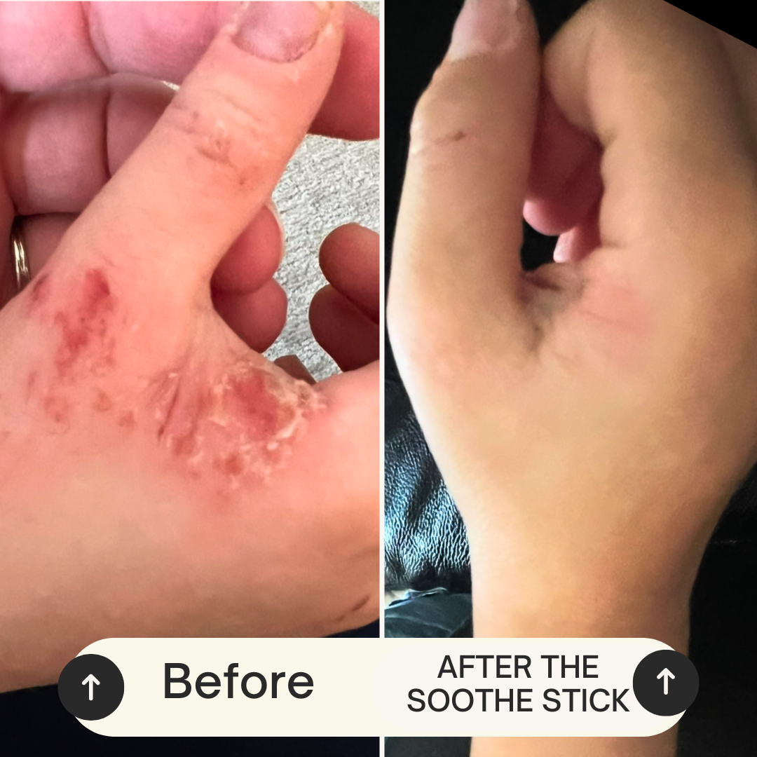 Soothe Stick Skin Balm Stick for Eczema and Dry, Cracked Skin, Soothing effect for itch and irritation