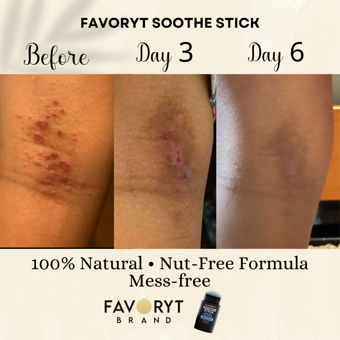 Soothe Stick Skin Balm Stick for Eczema and Dry, Cracked Skin, Soothing effect for itch and irritation